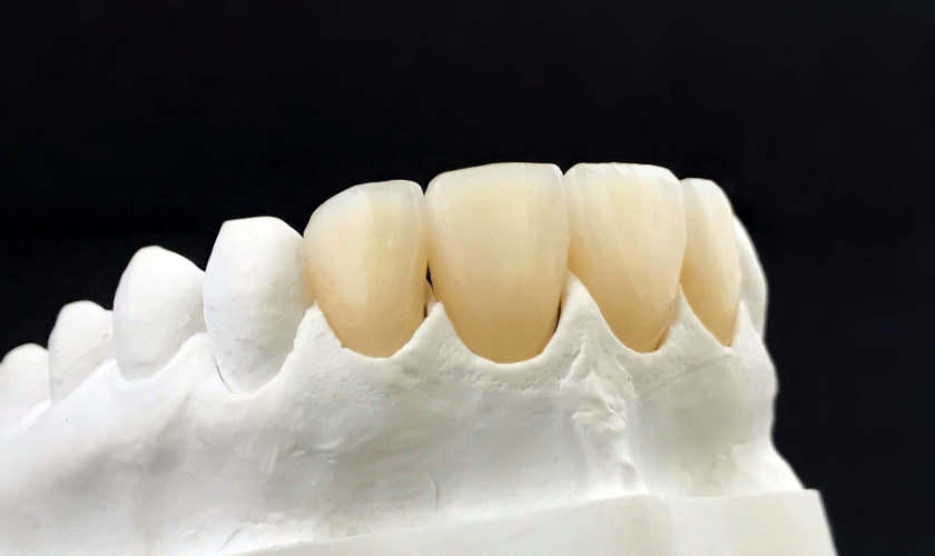 are same-day crowns good for front teeth