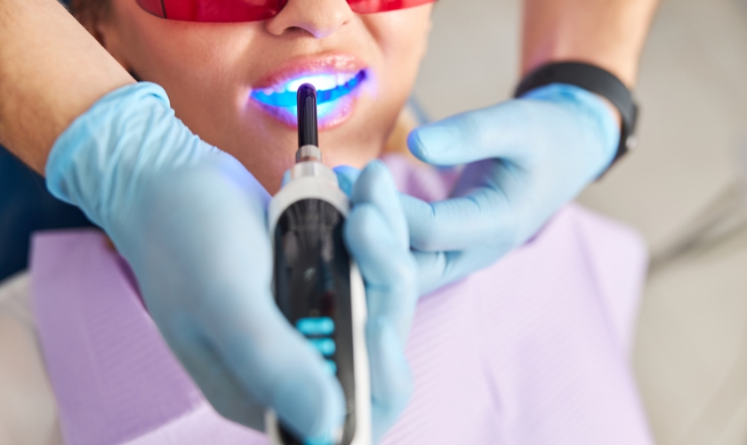 how long do laser teeth last