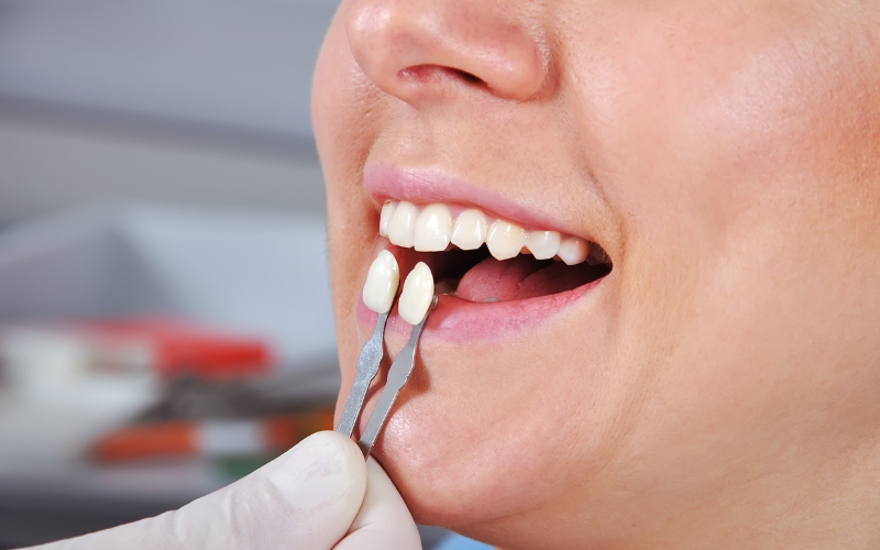 Featured image for “The Benefits of Same-Day Crowns for Dental Phobics”