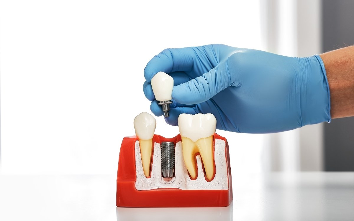 Featured image for “How Long Do Dental Implants Last? Understanding Durability and Maintenance”