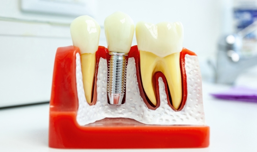 Featured image for “How Soon Can One Eat Normally After Getting Dental Implants? Your Recovery Diet Plan”
