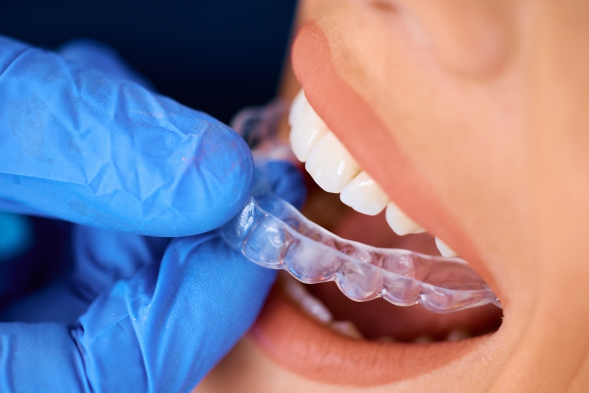 Featured image for “Can Invisalign Treat Adult Bite Issues Like Overbite or Crossbite?”