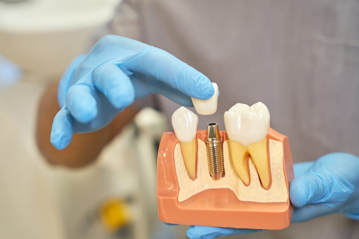 Featured image for “Dental Implants in Mesa, AZ | My Dentist Mesa”