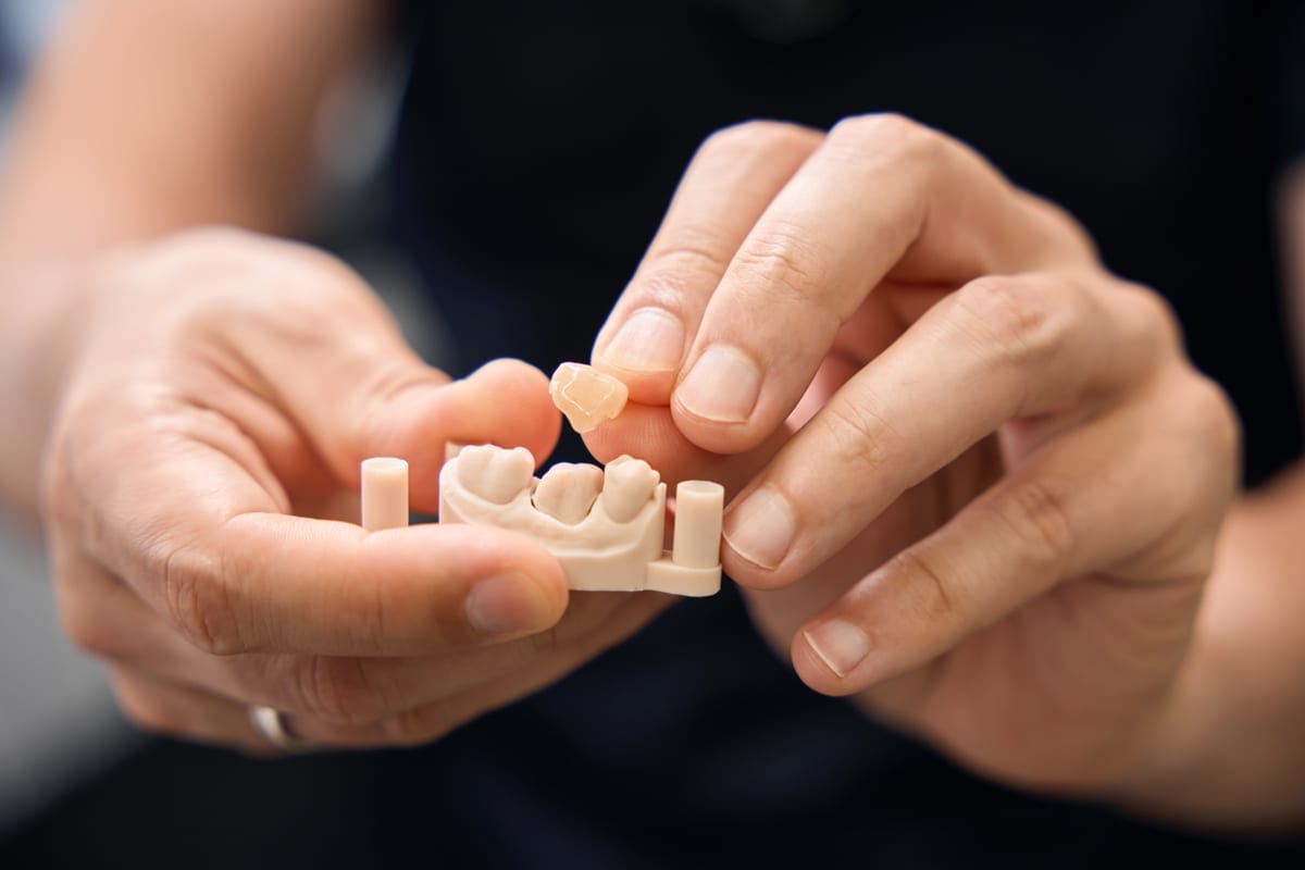 Dental Crowns in San Carlos
