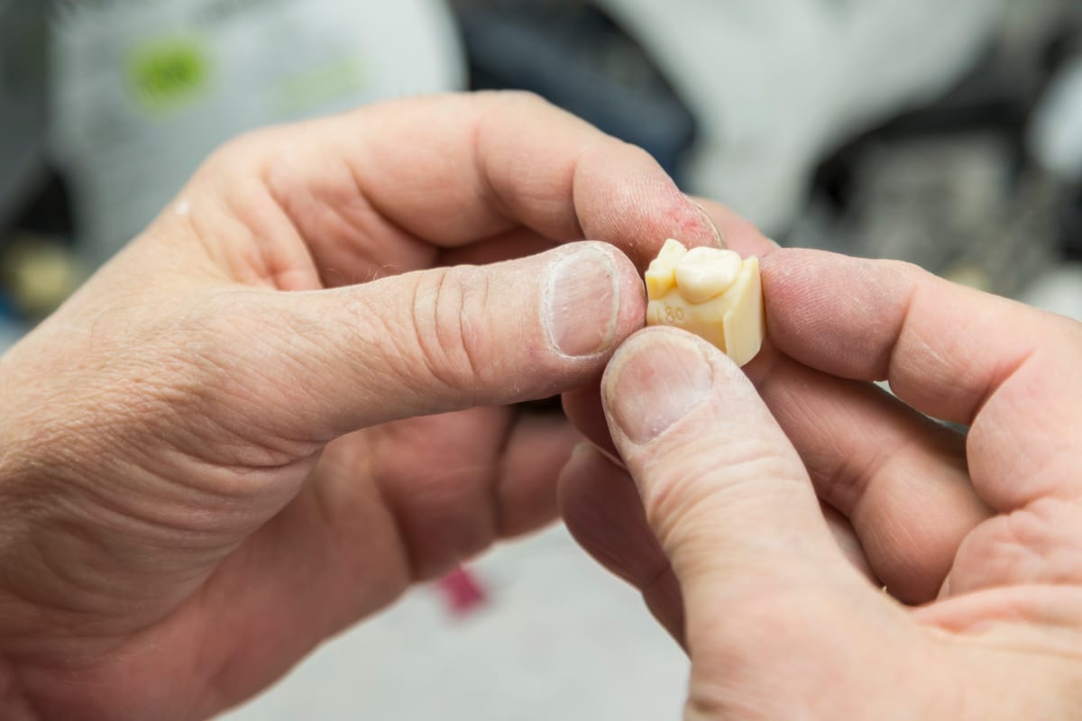 Dental Crowns in Mesa